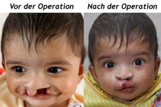 Lippenspalte OP